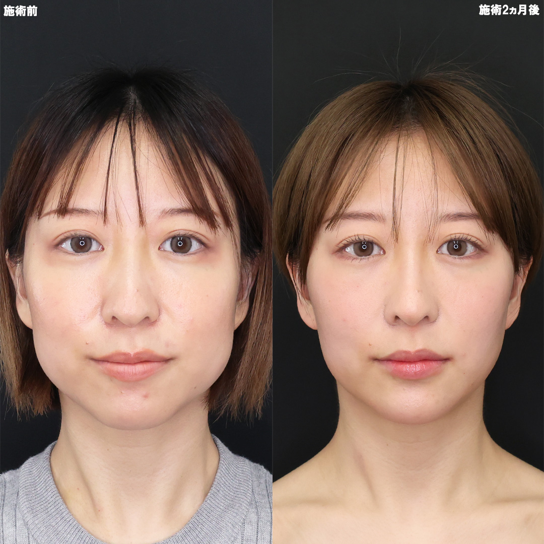 【糸リフト×バッカルファット除去】Dr.奥津の究極の小顔術