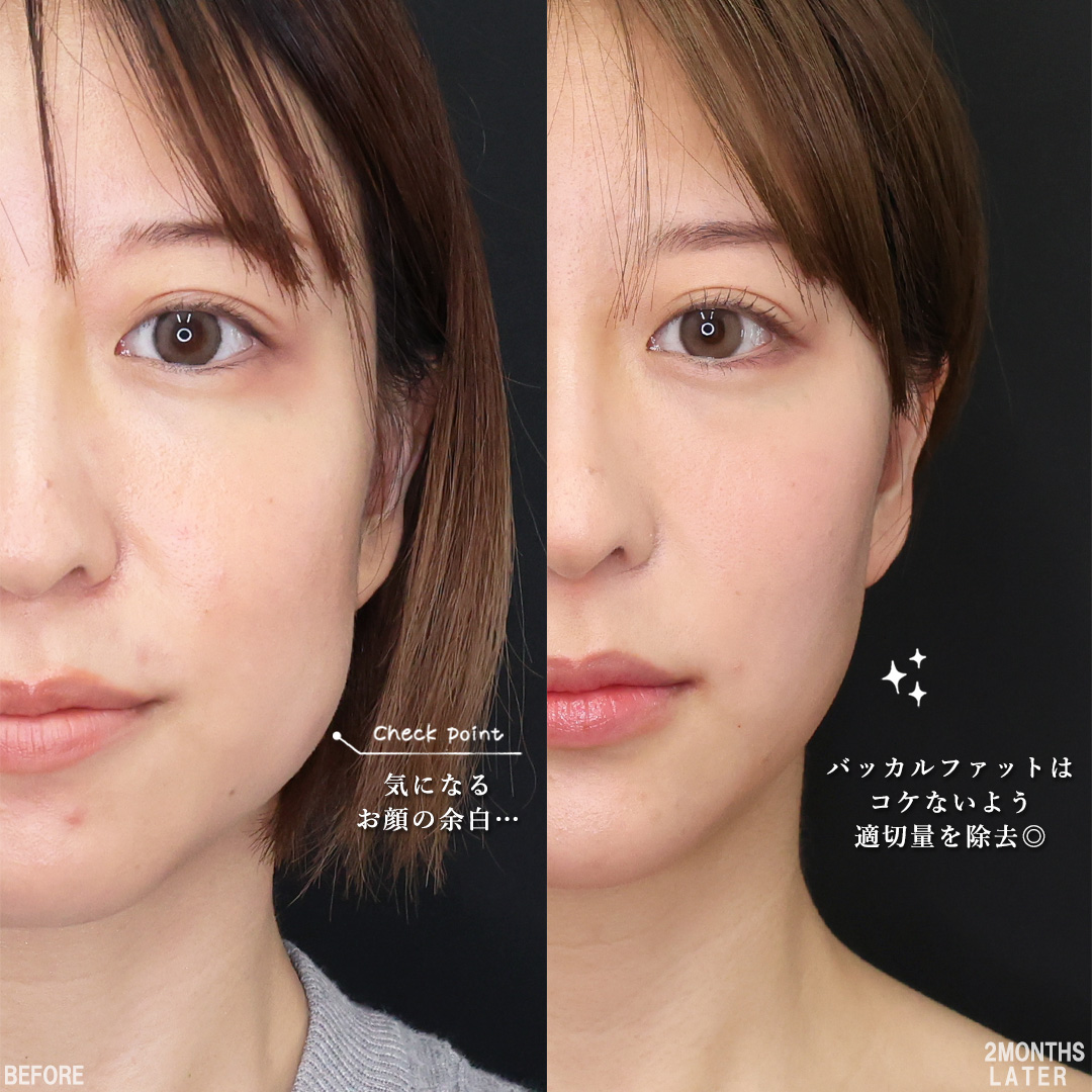バッカルファット除去/TAC式 ツヤ肌コラーゲンリフト®/TAC式 ショッピングリフトの症例写真 施術前後 