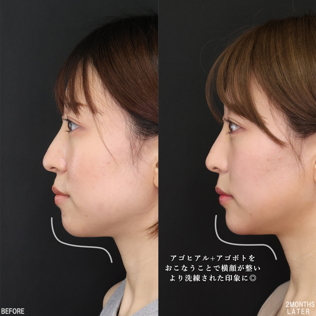 バッカルファット除去/TAC式 ツヤ肌コラーゲンリフト®/TAC式 ショッピングリフトの症例写真 施術前後 