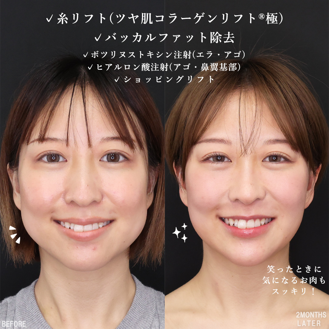バッカルファット除去/TAC式 ツヤ肌コラーゲンリフト®/TAC式 ショッピングリフトの症例写真 施術前後 