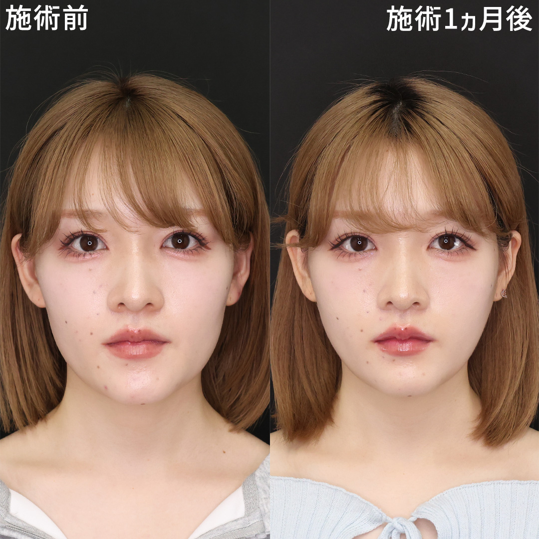 【脂肪除去×糸リフト】美を極める小顔術