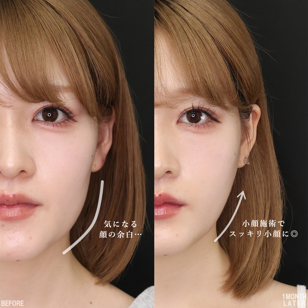 Lラインファット除去（エラ下脂肪除去）/TAC式 ツヤ肌コラーゲンリフト®/ボトックス注射：その他の症例写真 施術前後 