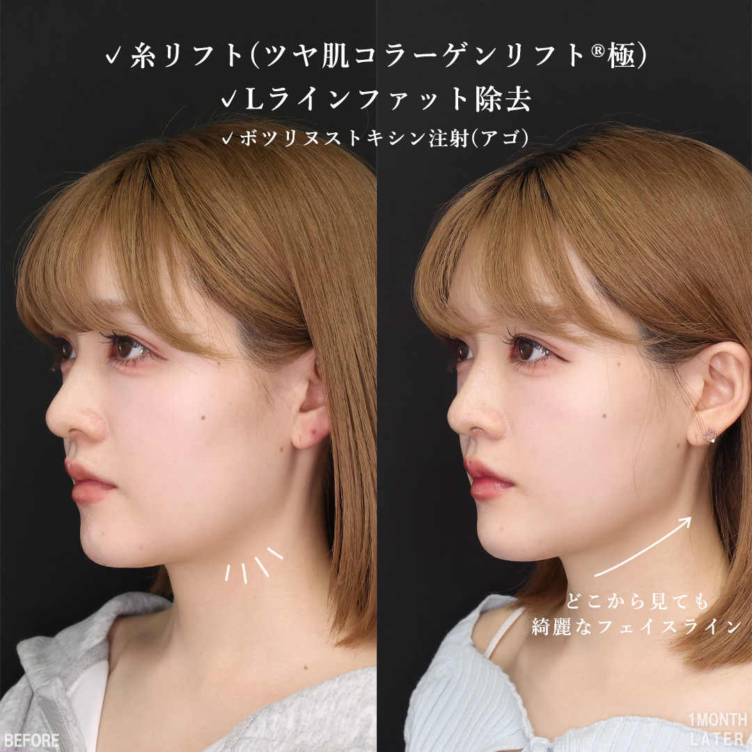 Lラインファット除去（エラ下脂肪除去）/TAC式 ツヤ肌コラーゲンリフト®/ボトックス注射：その他の症例写真 施術前後 