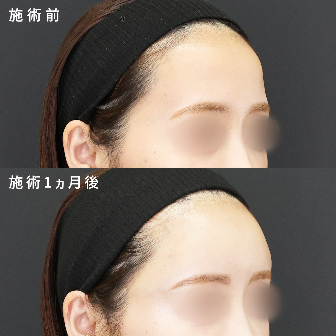 【おでこフィラー】ヒアルロン酸でまんまるおでこに