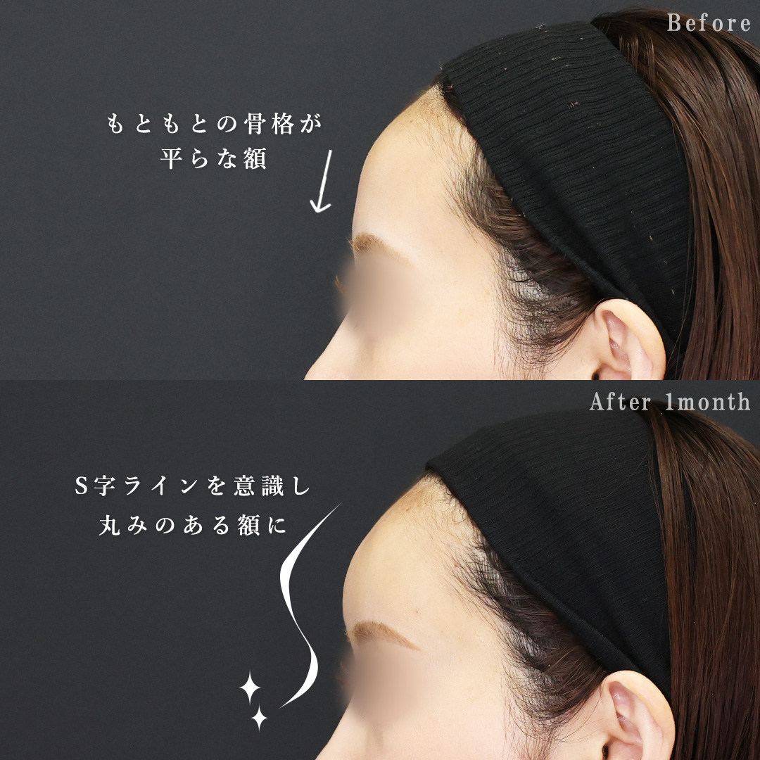 おでこ・こめかみのヒアルロン酸注射の症例写真 施術前後 