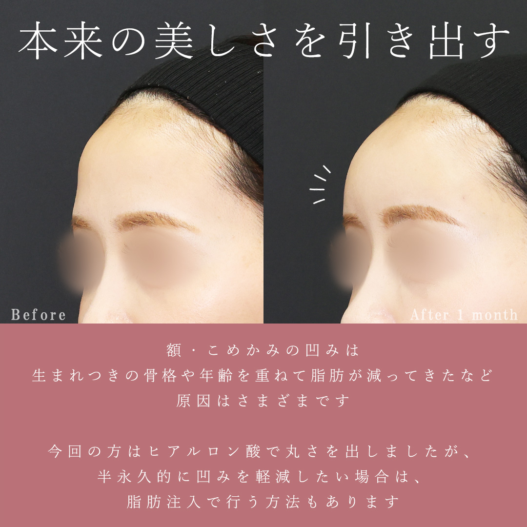 おでこ・こめかみのヒアルロン酸注射の症例写真 施術前後 