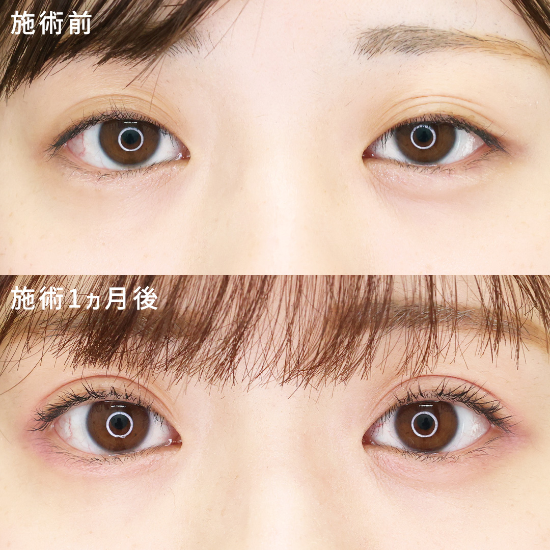 【アイテープ卒業！】幅広Mix型二重で明るい印象に