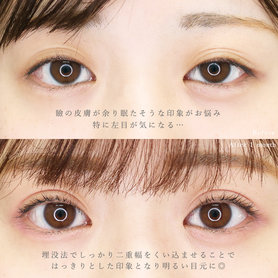 二重埋没法の症例写真 施術前後 