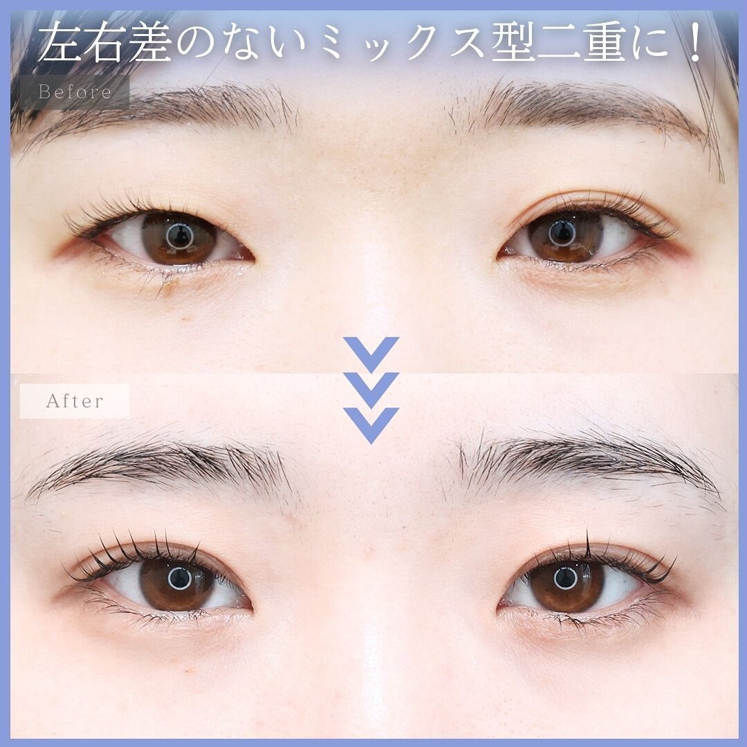 二重埋没法の症例写真 施術前後 