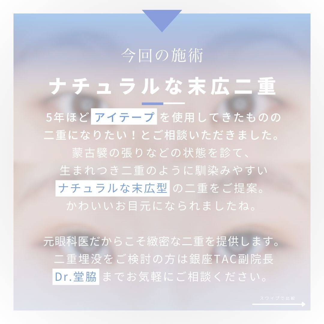 二重埋没法の症例写真 施術前後 