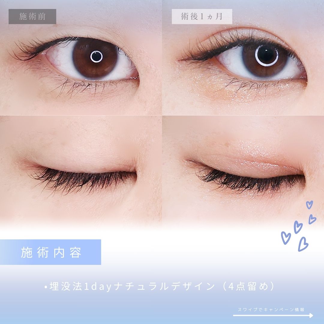 二重埋没法の症例写真 施術前後 