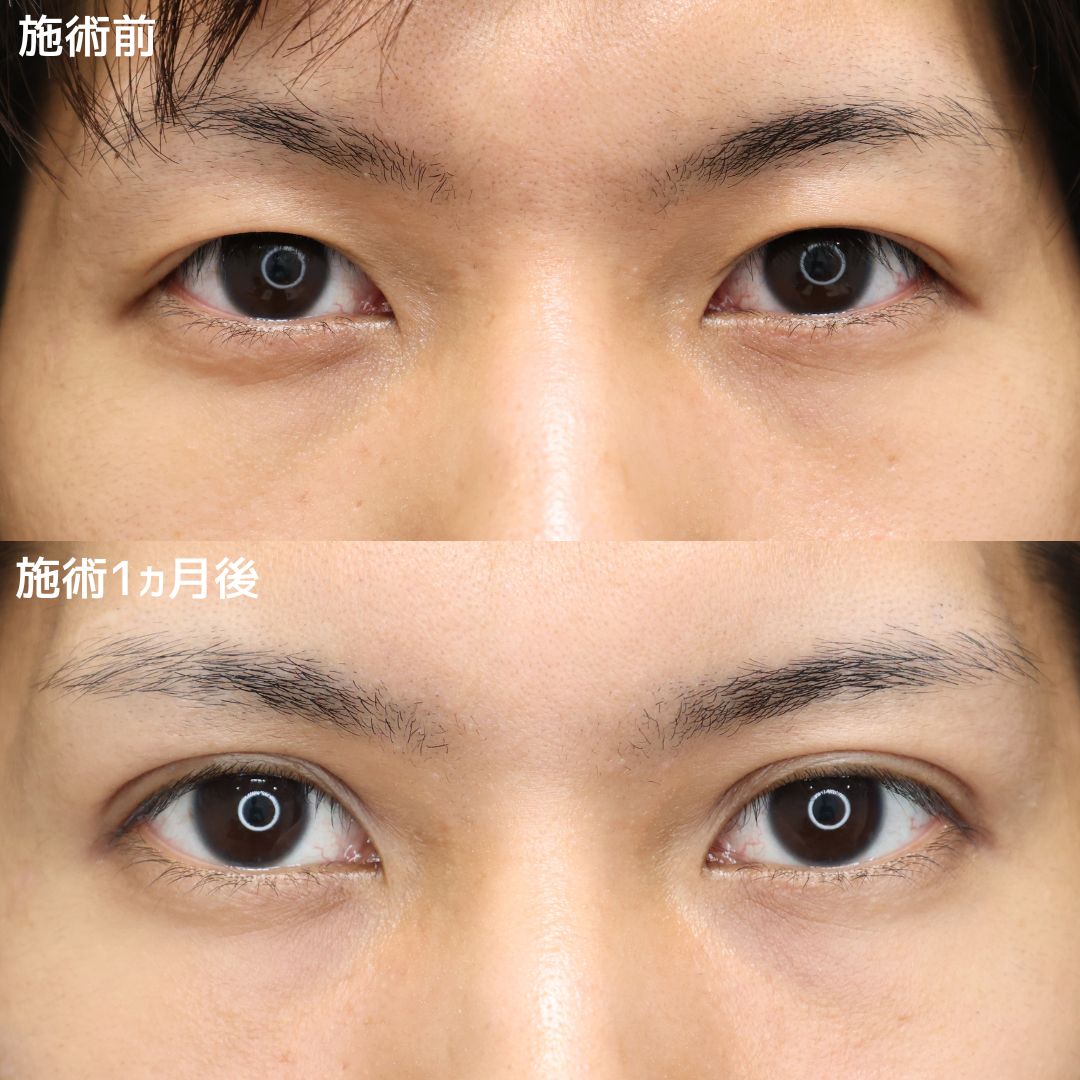 【メンズ二重術】ダウンタイムは最小限にここまで変わる