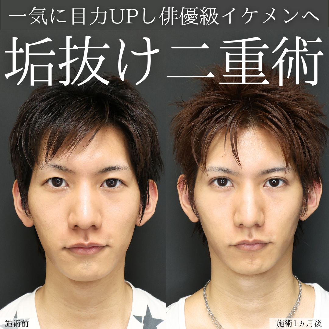 二重埋没法/ヒアルロン酸注射：その他/ボトックス注射：その他の症例写真 施術前後 