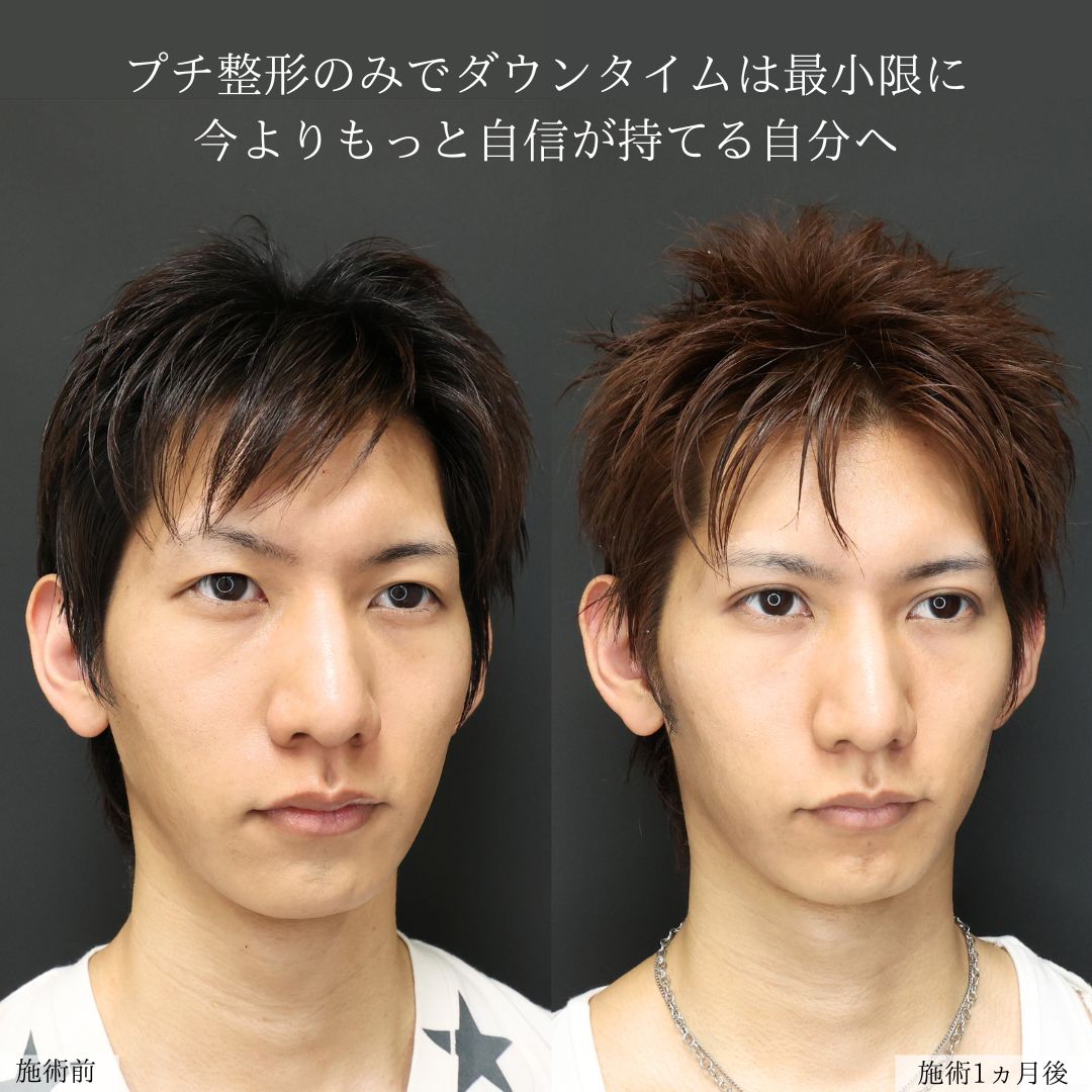 二重埋没法/ヒアルロン酸注射：その他/ボトックス注射：その他の症例写真 施術前後 