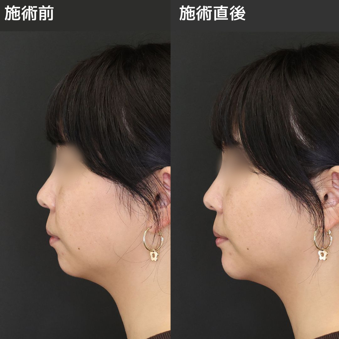 《アゴヒアル》整形感なくナチュラルにEラインを整える