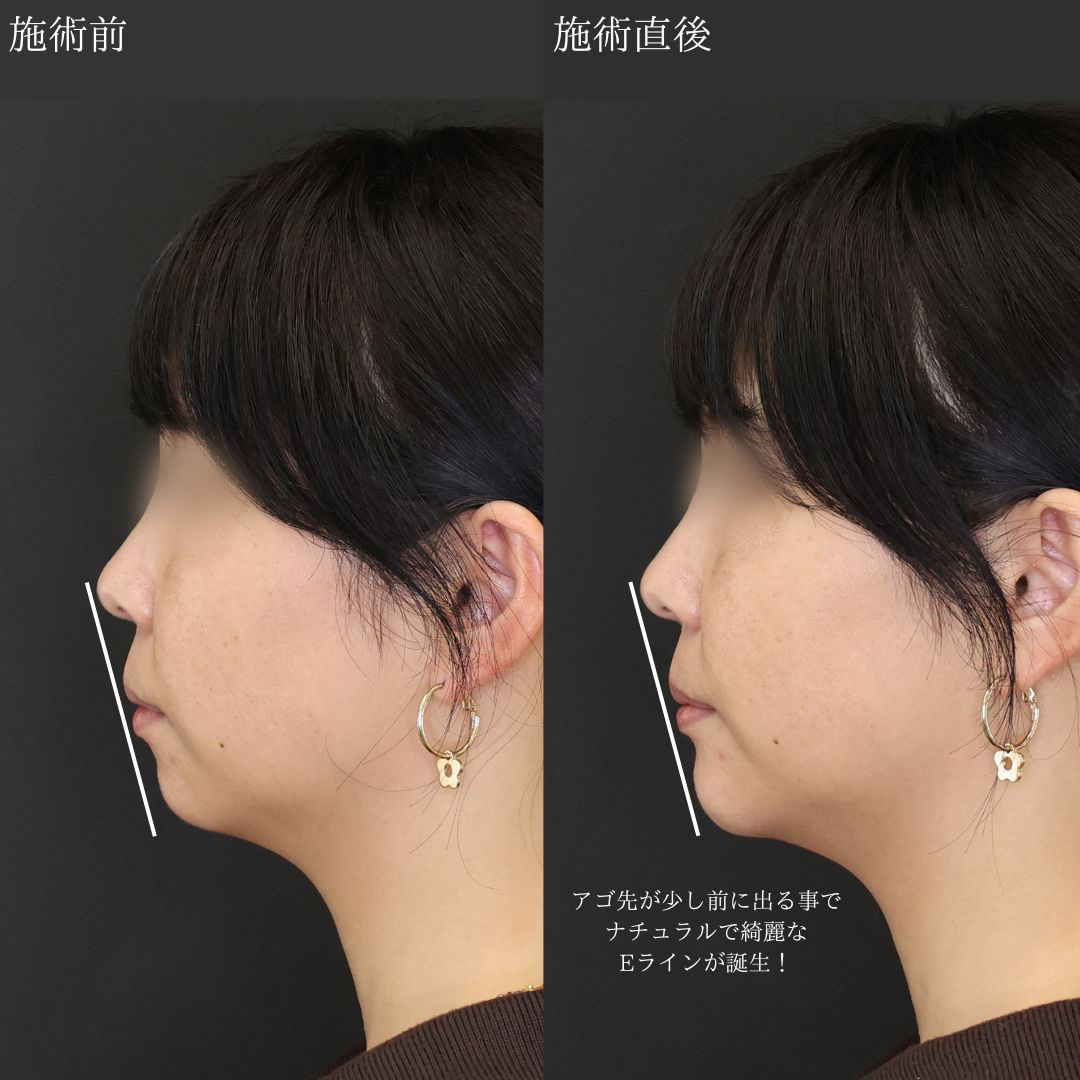 顎のヒアルロン酸注射/ボトックス注射：その他の症例写真 施術前後 