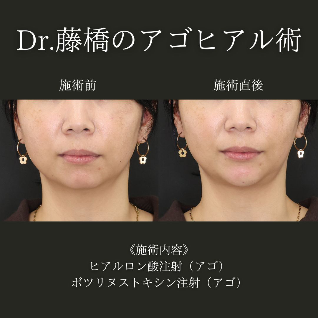 顎のヒアルロン酸注射/ボトックス注射：その他の症例写真 施術前後 