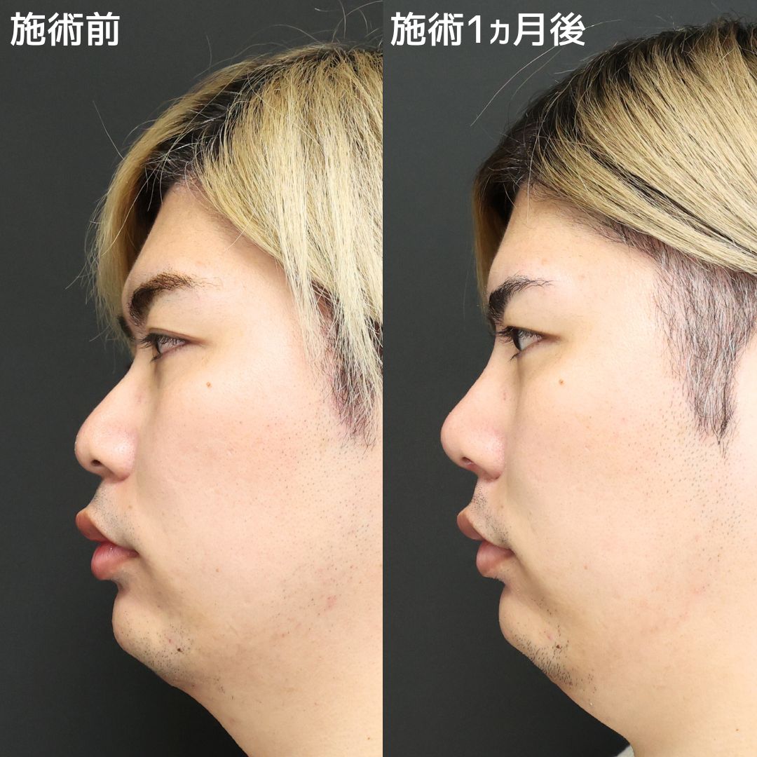 鼻整形】形成外科専門医だからこそ作れる美鼻デザイン｜症例写真