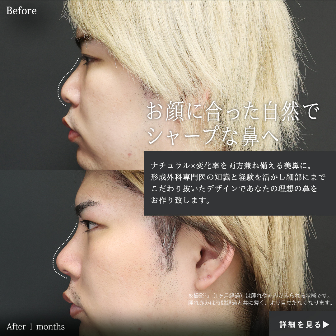 鼻尖形成・鼻尖縮小/隆鼻術（プロテーゼ・自家組織）の症例写真 施術前後 