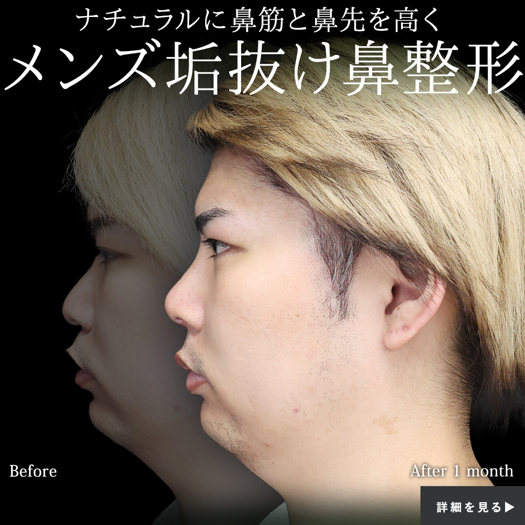 鼻尖形成・鼻尖縮小/隆鼻術（プロテーゼ・自家組織）の症例写真 施術前後 