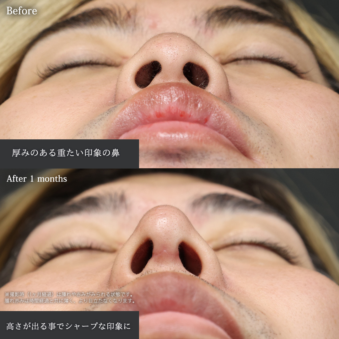 鼻尖形成・鼻尖縮小/隆鼻術（プロテーゼ・自家組織）の症例写真 施術前後 