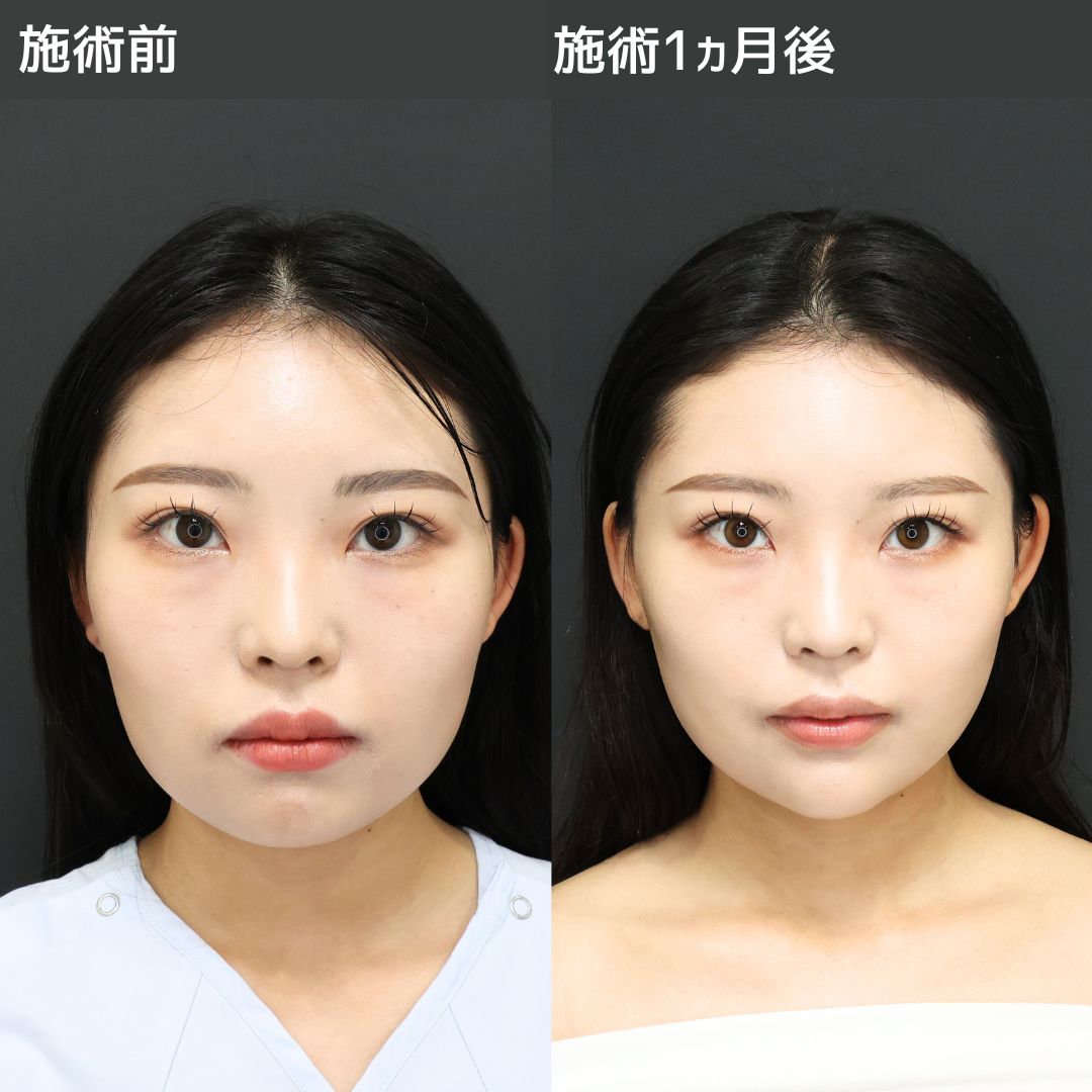 《小顔整形》で正面だけでなく横顔も美しく