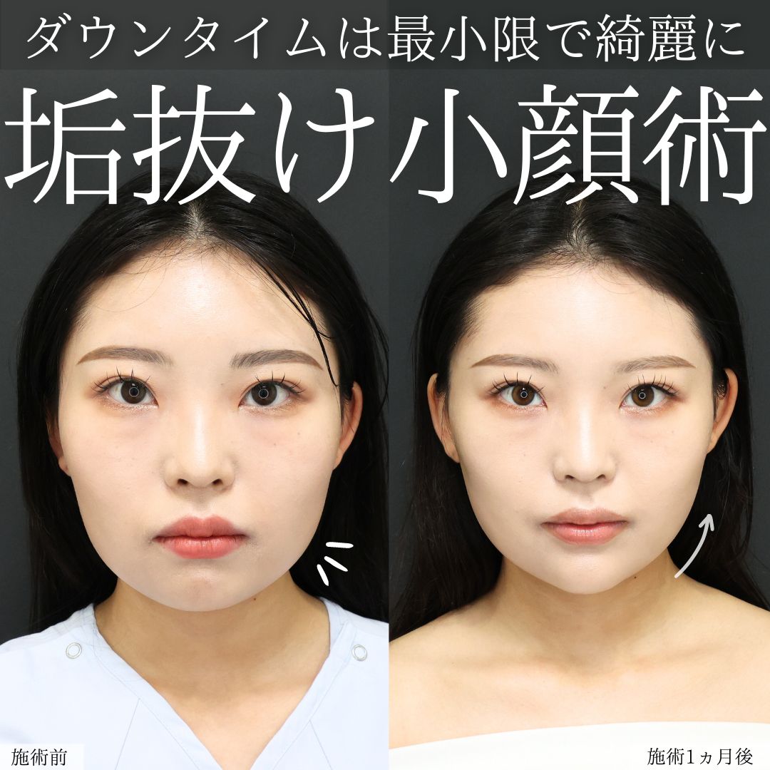 TAC式 ツヤ肌コラーゲンリフト®/Lラインファット除去（エラ下脂肪除去）/顔の脂肪吸引の症例写真 施術前後 