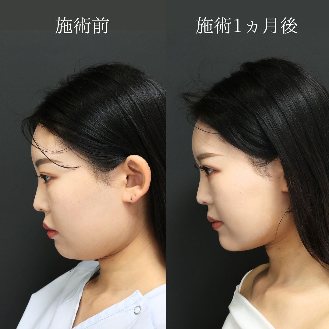 TAC式 ツヤ肌コラーゲンリフト®/Lラインファット除去（エラ下脂肪除去）/顔の脂肪吸引の症例写真 施術前後 
