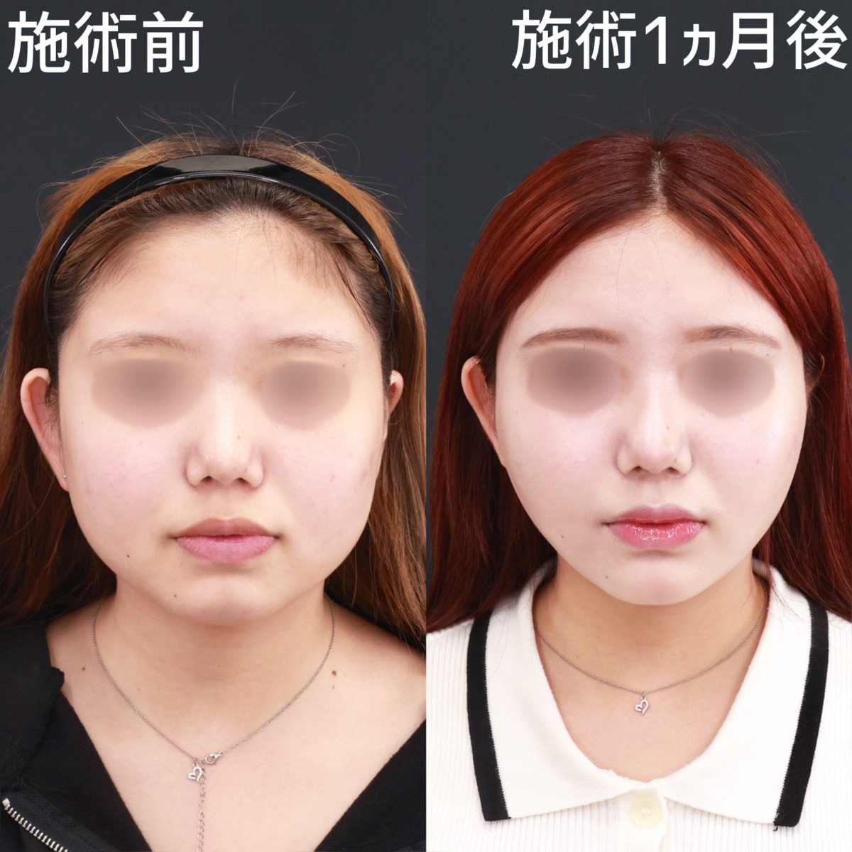 小顔整形|パーフェクトフェイスライン/TAC式 ツヤ肌コラーゲンリフト®/ジョールファット除去の症例写真 施術前後