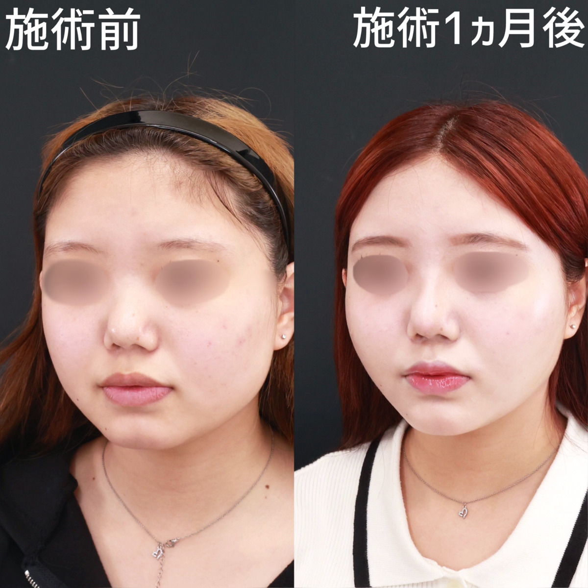 小顔整形|パーフェクトフェイスライン/TAC式 ツヤ肌コラーゲンリフト®/ジョールファット除去の症例写真 施術前後