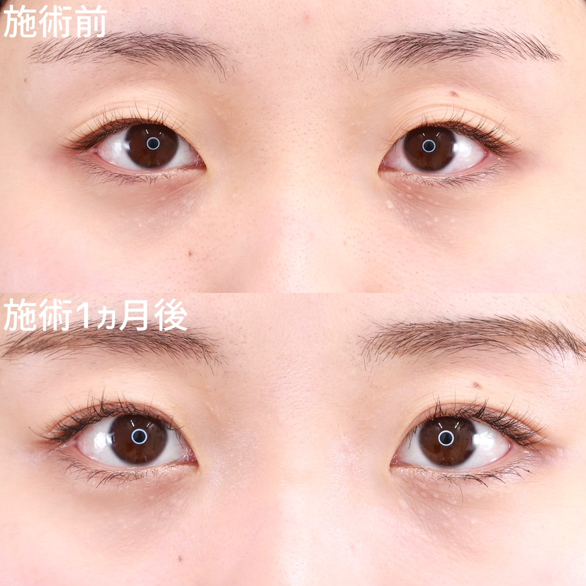 【二重埋没法】クッキリと安定した二重ラインに！