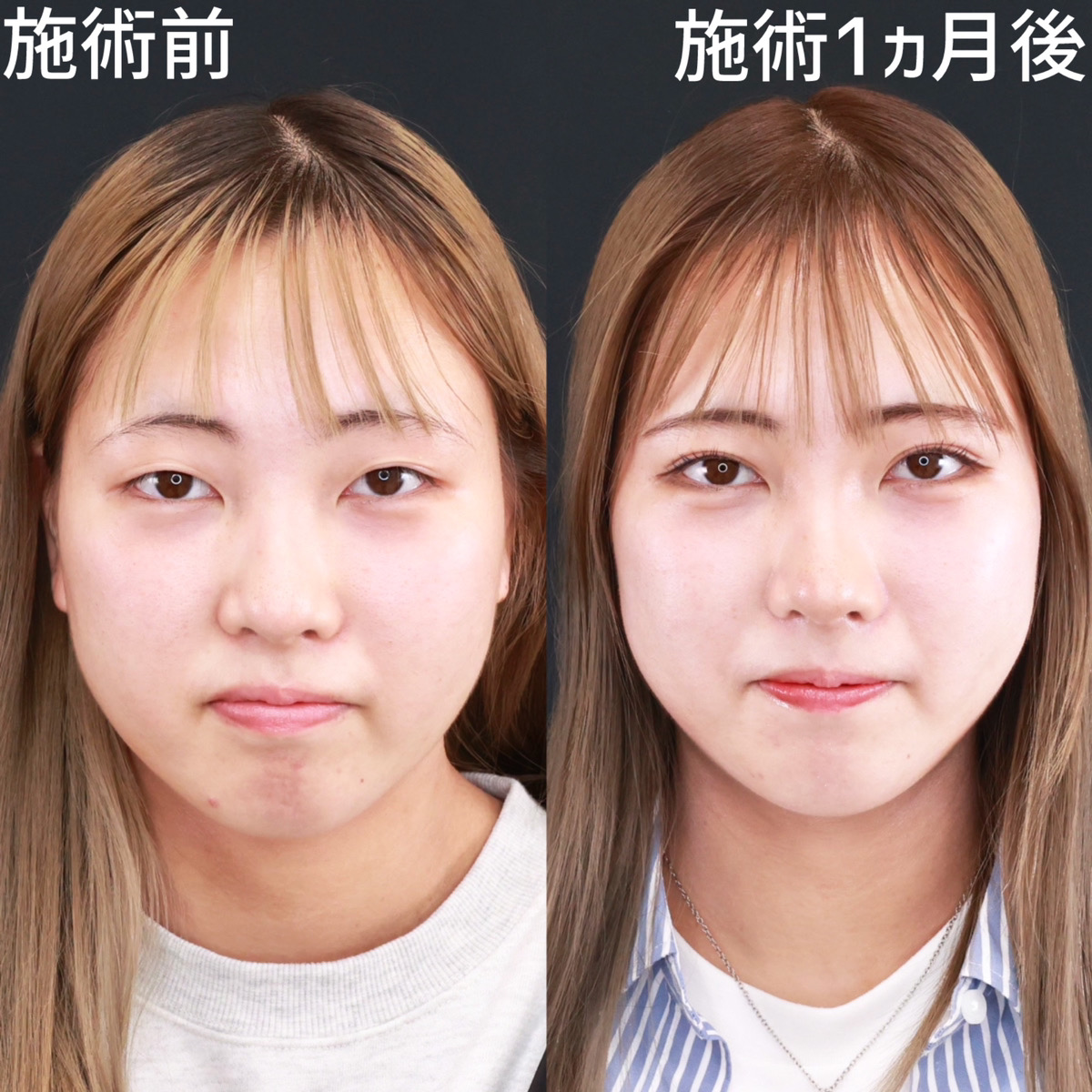 クイックコスメリングの症例写真 施術前後