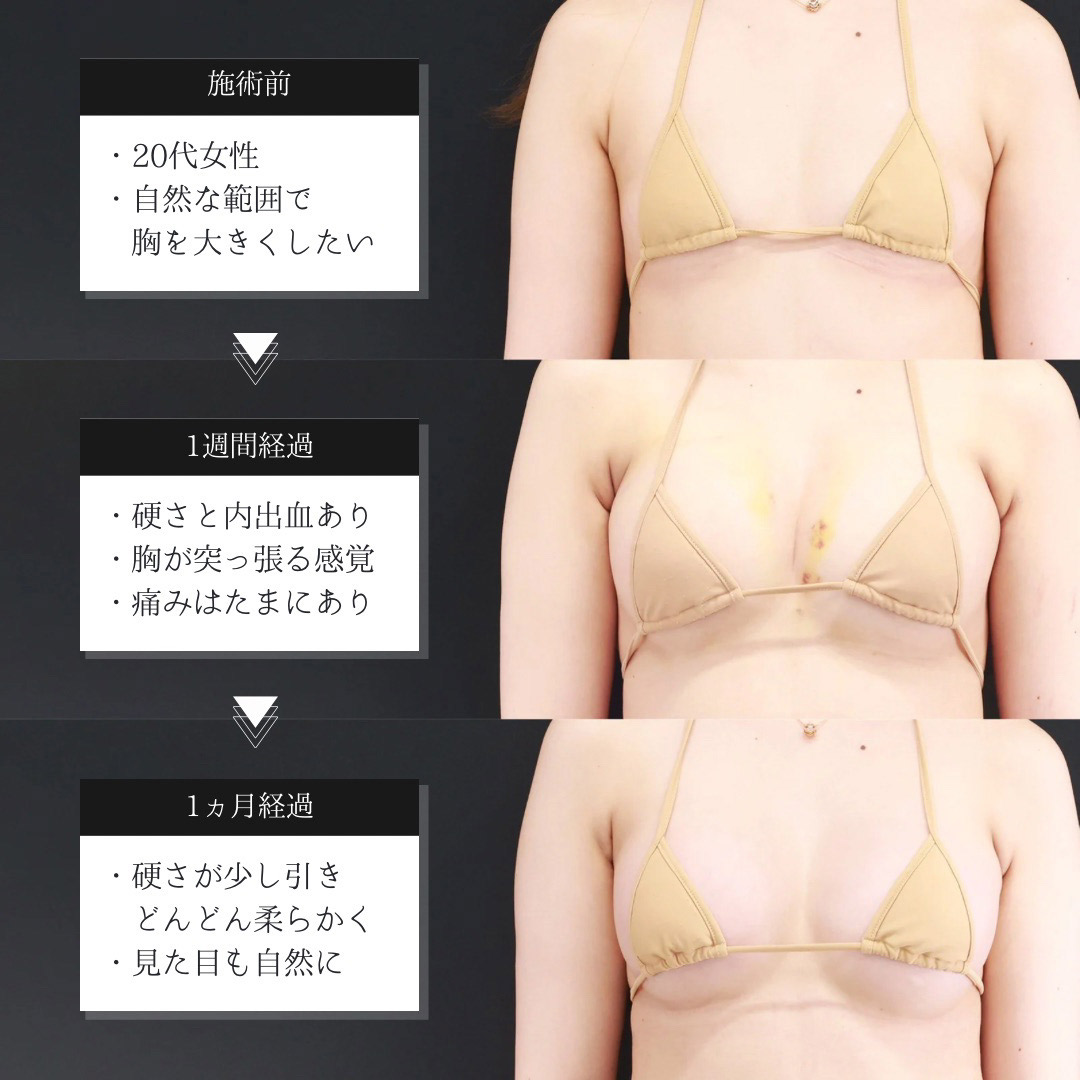 体の脂肪吸引/シリコンバッグ豊胸(人工乳腺バッグ)の症例写真 施術前後