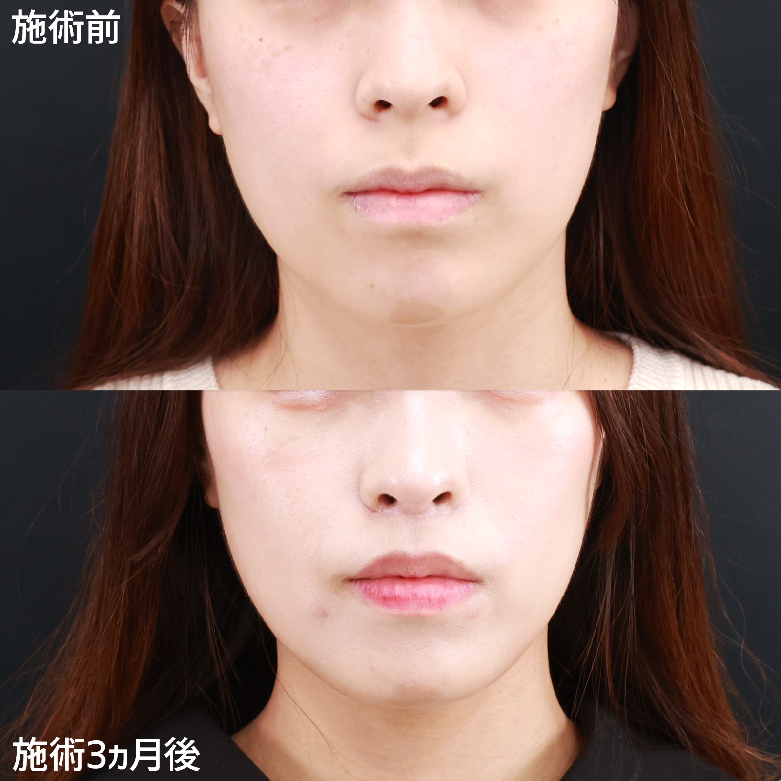 【人中短縮術】気になる長い鼻下を短くして、面長感を改善！