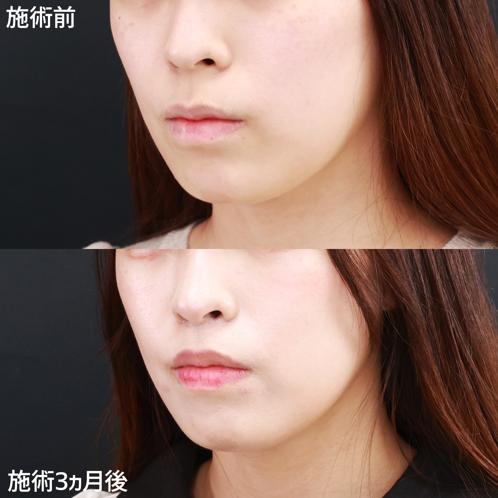 人中短縮術(リップリフト)・外側人中短縮術/TAC式 鼻翼縮小術（小鼻縮小）の症例写真 施術前後 