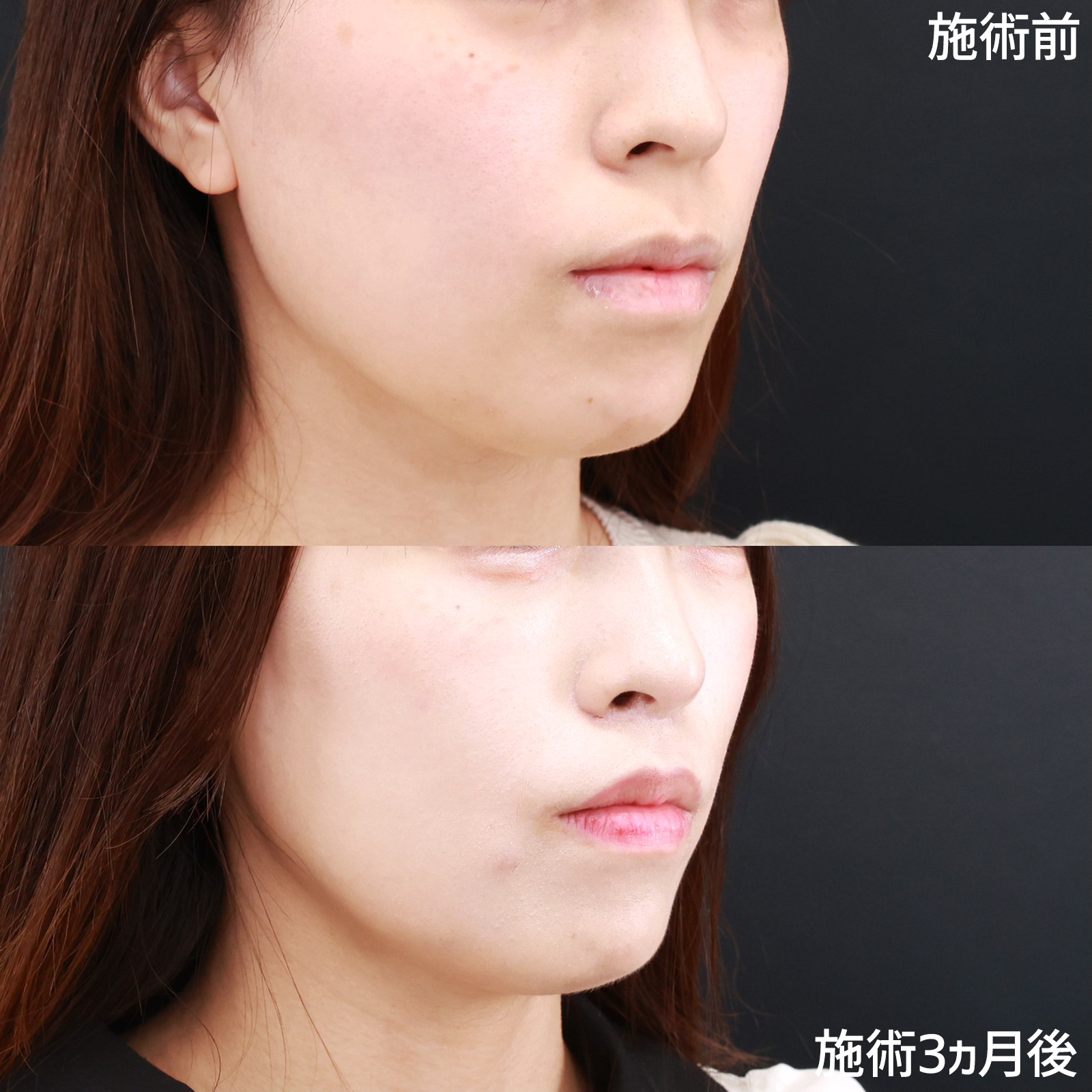 人中短縮術(リップリフト)・外側人中短縮術/TAC式 鼻翼縮小術（小鼻縮小）の症例写真 施術前後 