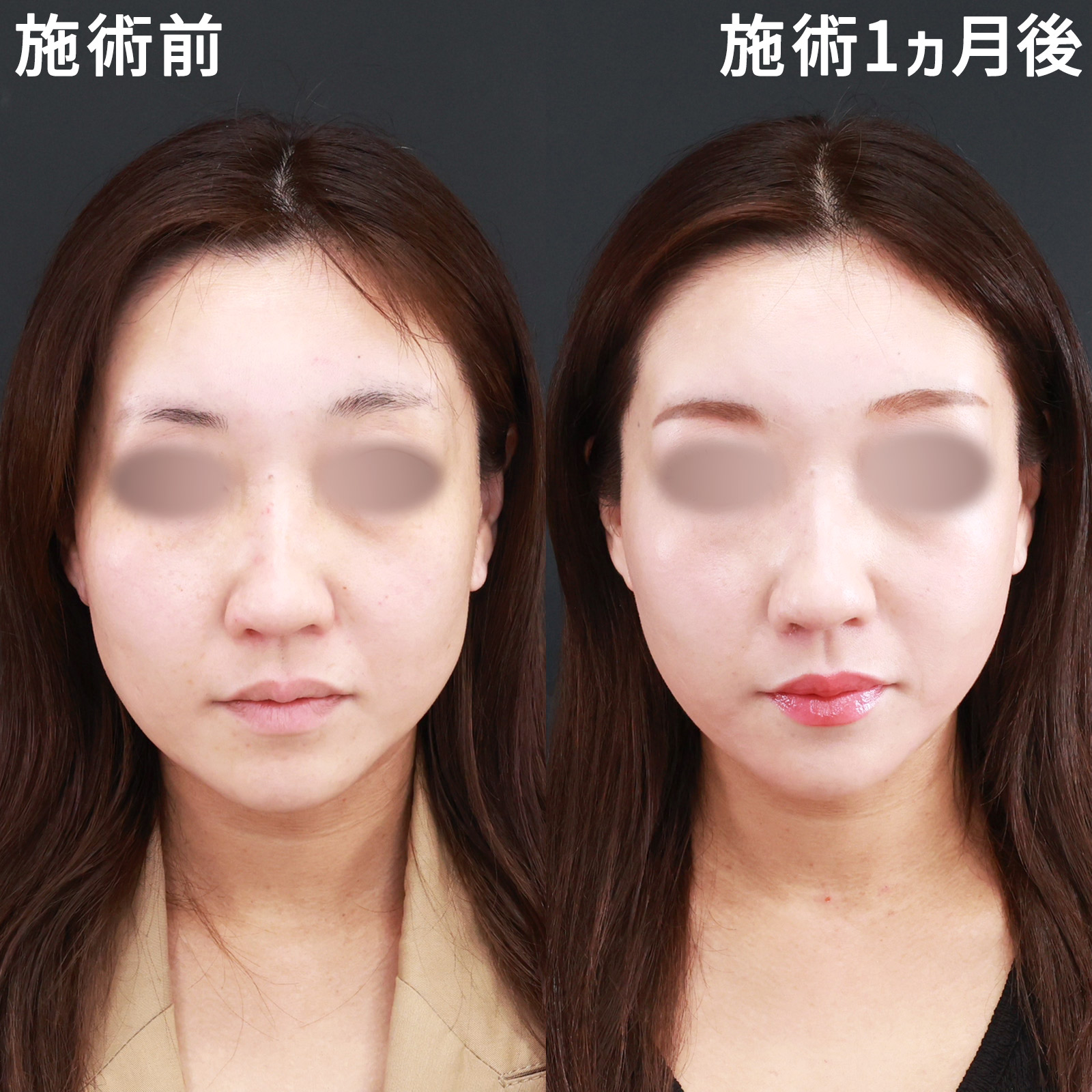 【糸リフト極＆小顔注射】エラ張りを解消し、お顔を一回り小さく