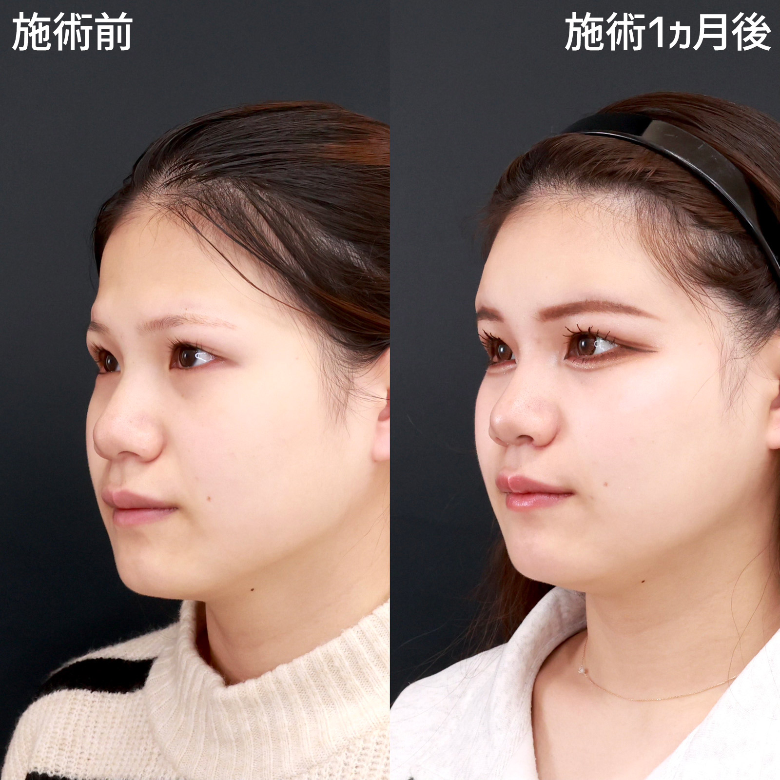 顔の脂肪注入(コンデンスリッチフェイス)の症例写真 施術前後 