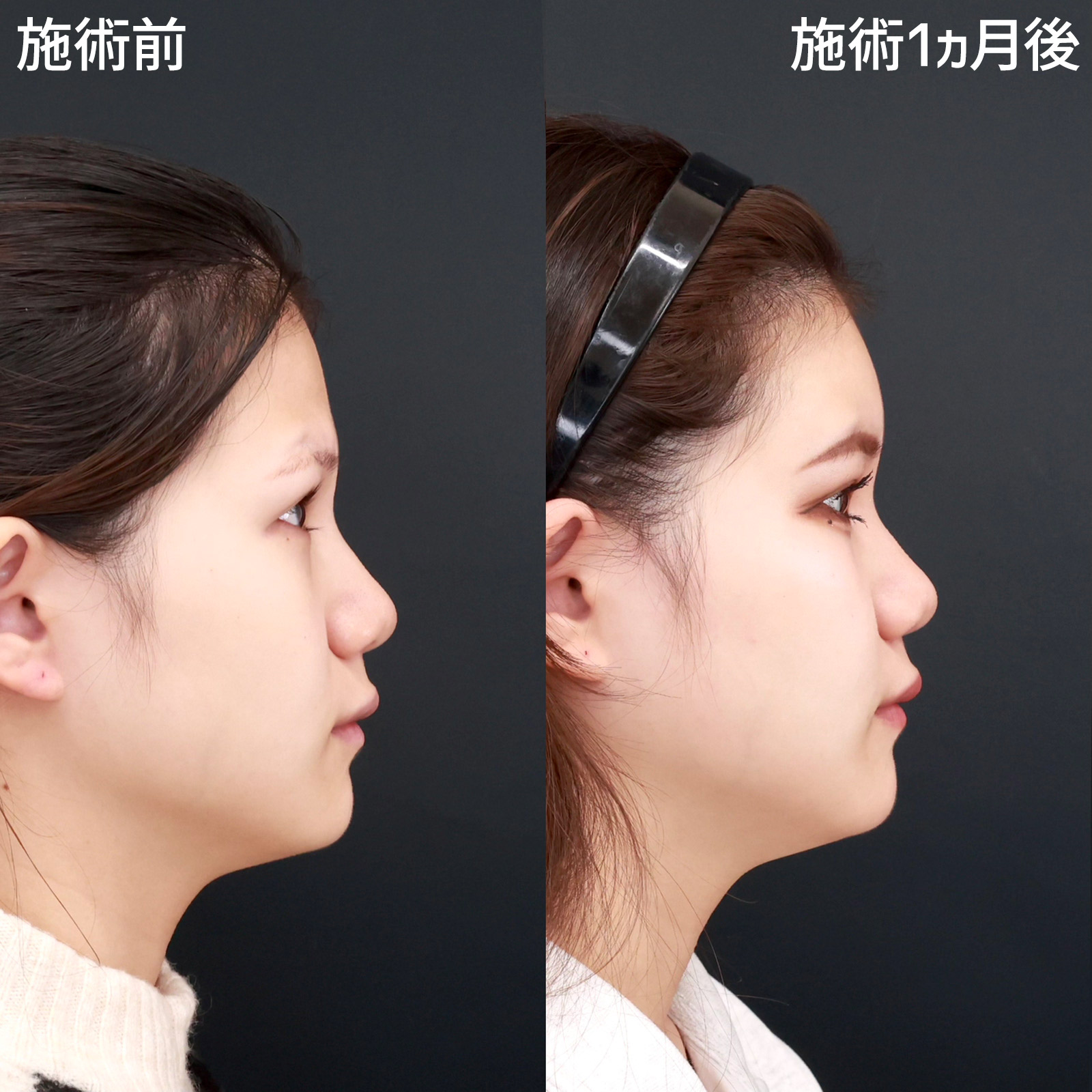 顔の脂肪注入(コンデンスリッチフェイス)の症例写真 施術前後 