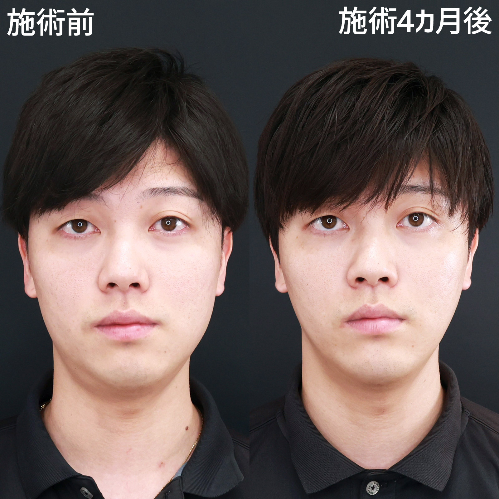 【パーフェクトフェイスライン】女性だけじゃない！男性の垢抜けにも“小顔整形”がおすすめ