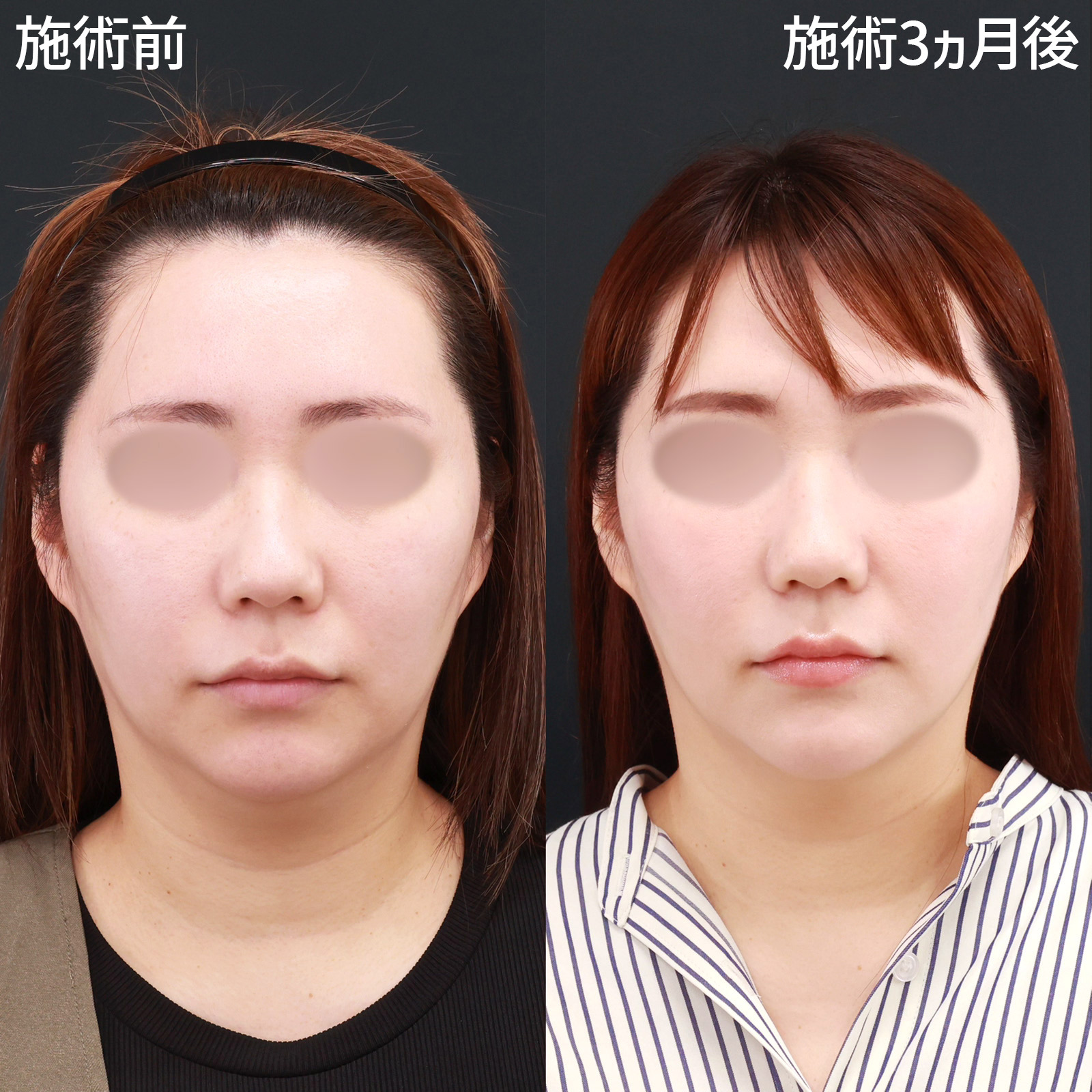 TAC式 ツヤ肌コラーゲンリフト®/顔の脂肪吸引/Lラインファット除去(エラ下脂肪除去)の症例写真 施術前後