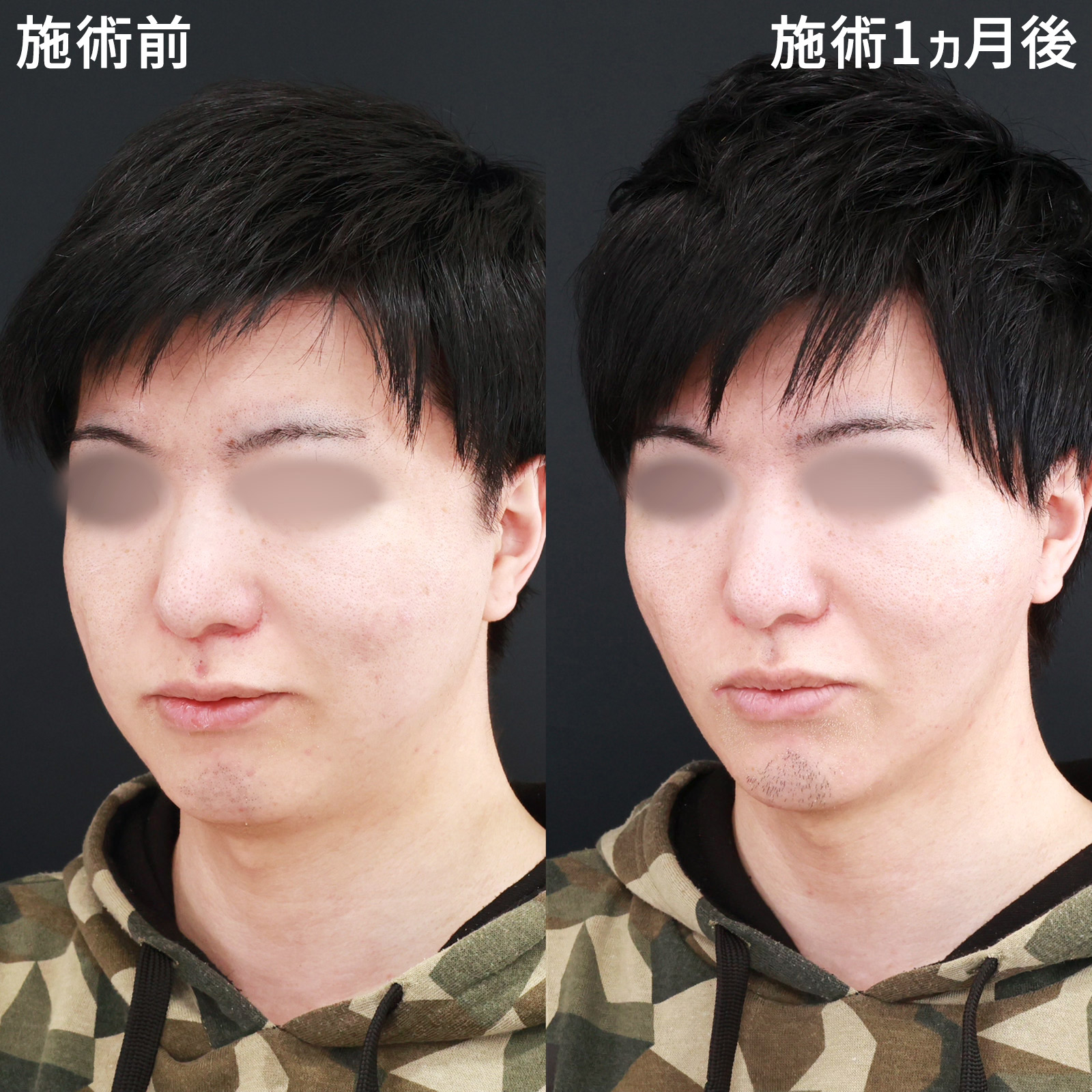 TAC式 ツヤ肌コラーゲンリフト®/バッカルファット除去/ジョールファット除去の症例写真 施術前後 