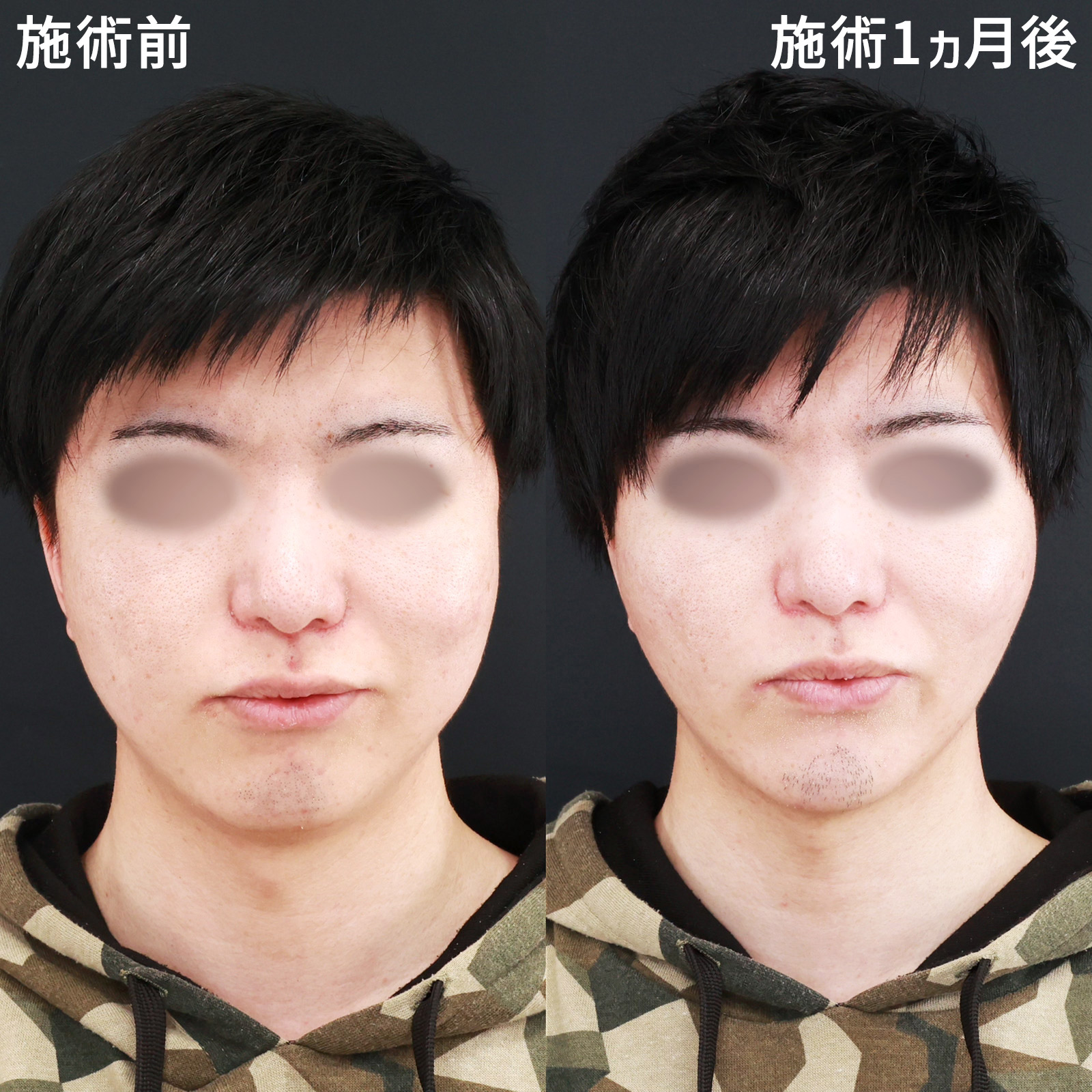 TAC式 ツヤ肌コラーゲンリフト®/バッカルファット除去/ジョールファット除去の症例写真 施術前後 