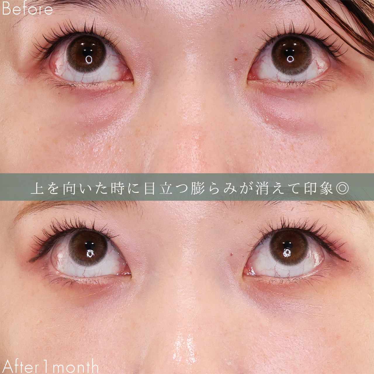 下眼瞼脱脂術(目の下のたるみ取り・目の下の脂肪ふくらみ取り)の症例写真 施術前後