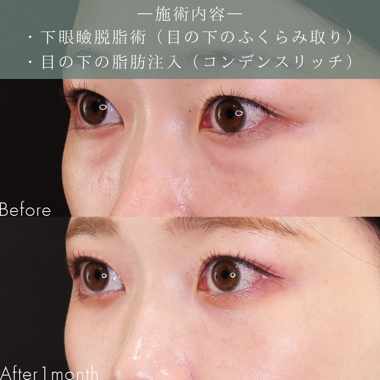 下眼瞼脱脂術(目の下のたるみ取り・目の下の脂肪ふくらみ取り)の症例写真 施術前後