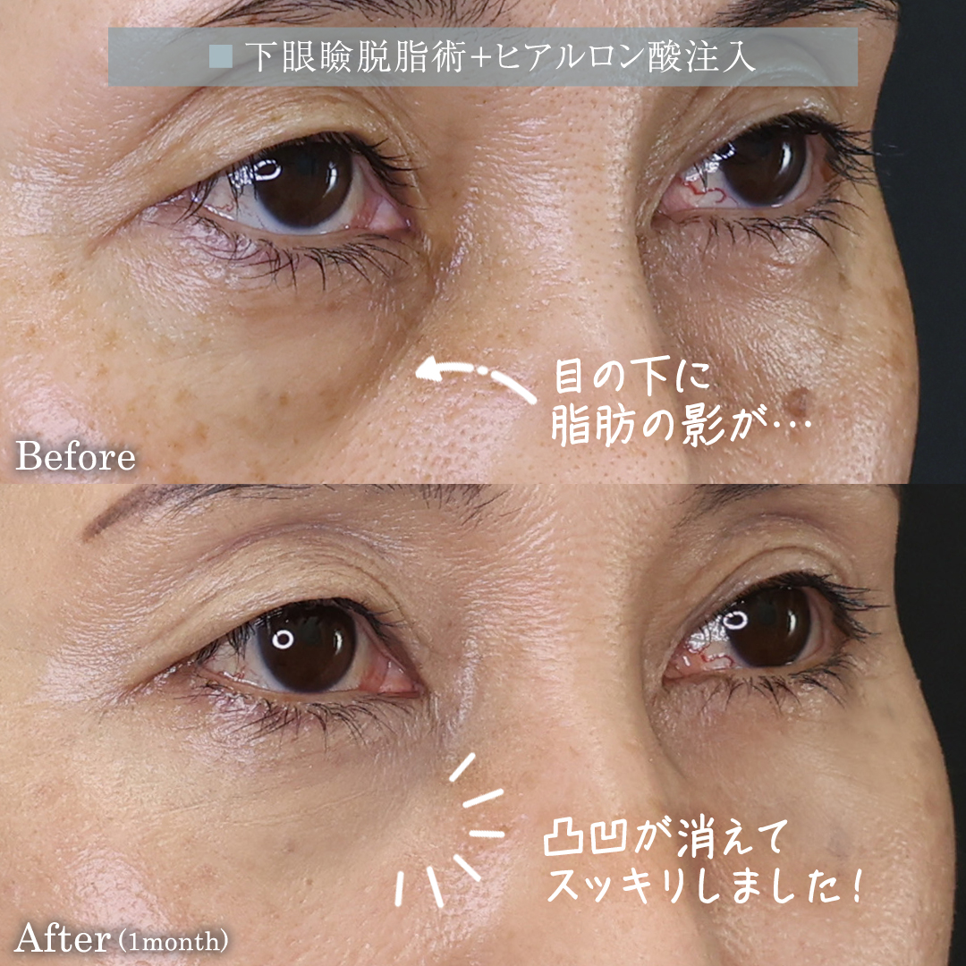 下眼瞼脱脂術（目の下のたるみ取り・目の下の脂肪ふくらみ取り）/目の下のヒアルロン酸注射の症例写真 施術前後 