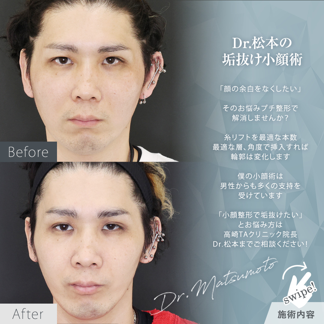 TAC式 ツヤ肌コラーゲンリフト®/ヒアルロン酸注射：その他の症例写真 施術前後 