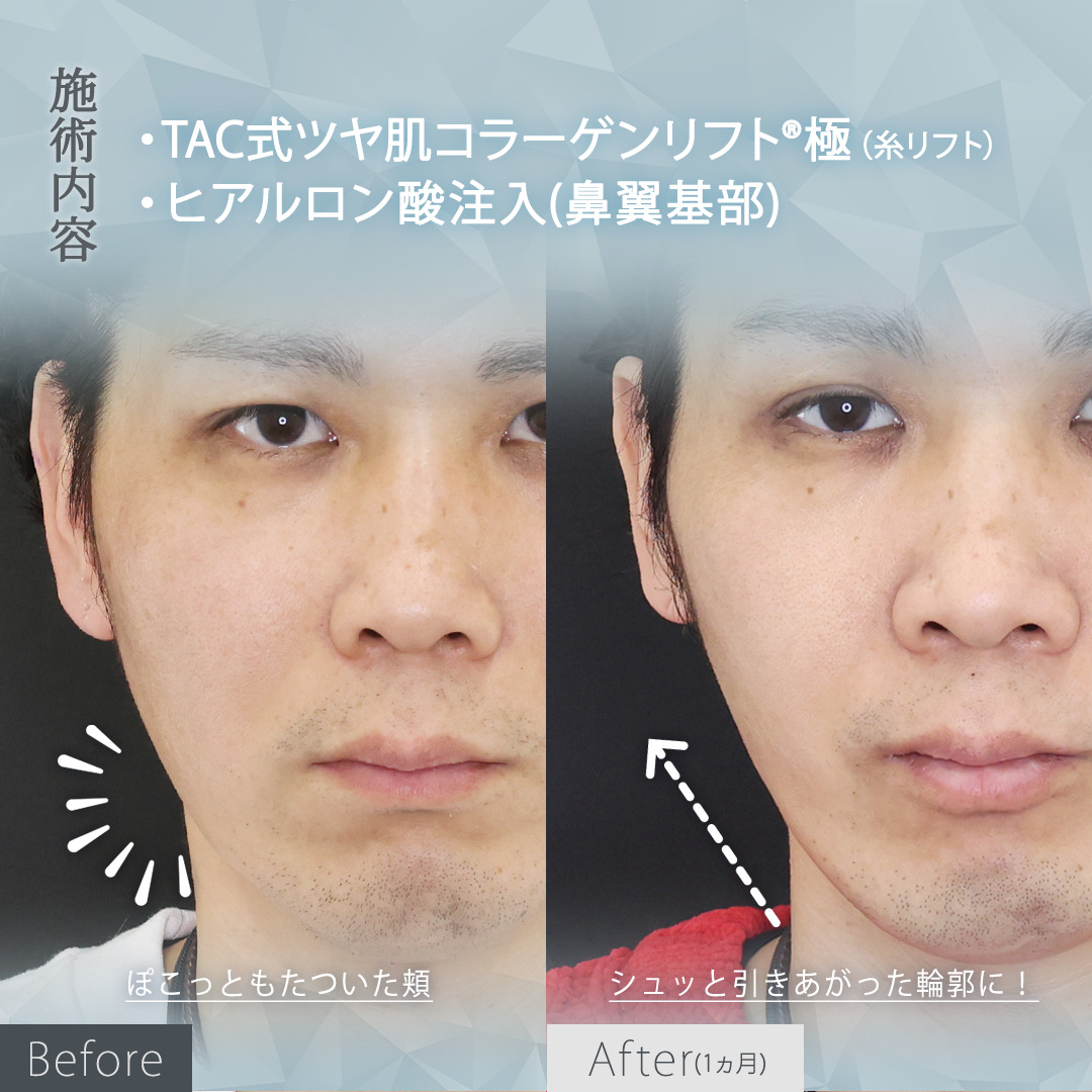 TAC式 ツヤ肌コラーゲンリフト®/ヒアルロン酸注射：その他の症例写真 施術前後 