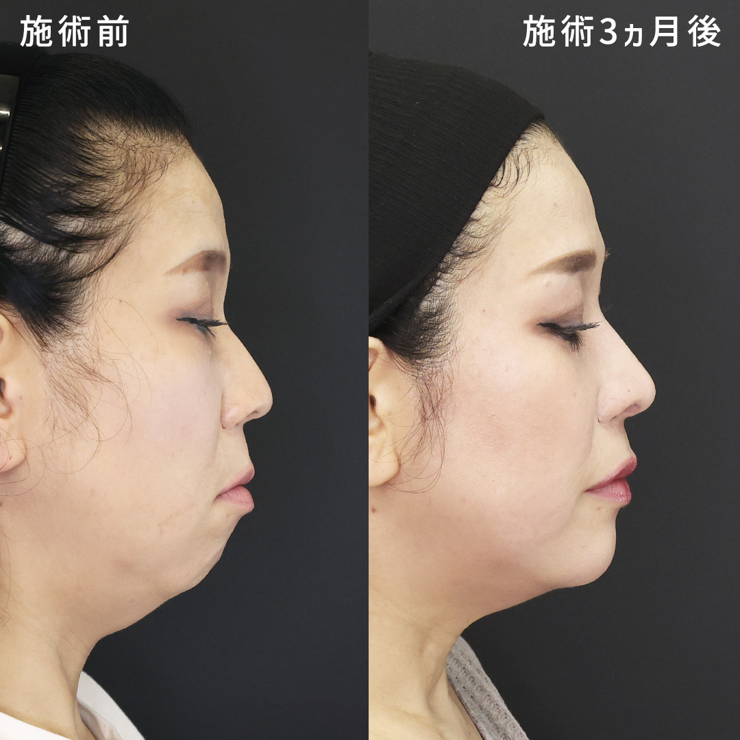 【別人級の横顔美人に】形成外科専門医が行う、自然なEライン形成