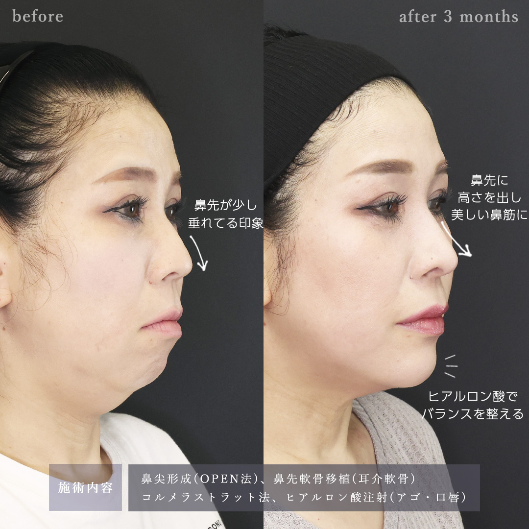 鼻尖形成・鼻尖縮小/鼻先軟骨移植/顎のヒアルロン酸注射の症例写真 施術前後 